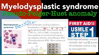 Myelodysplastic syndrome amp PseudoPelgerHuet anomaly in HindiUrdu by first aid for USMLE step 1 [upl. by Armahs]