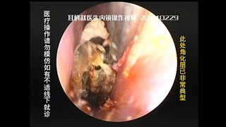 External auditory canal cholesteatoma with very narrow entrance 20240229 [upl. by Llewoh]