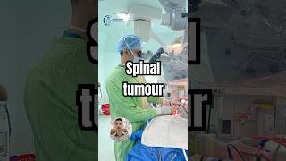 Spine tumour treatment  Cancer of spine treatment  Neurosurgeon [upl. by Nolos]