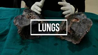 Lungs  gross anatomy [upl. by Carri709]