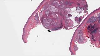 Salivary Gland Tumor Mucoepidermoid Carcinoma Micro Tips [upl. by Marpet]