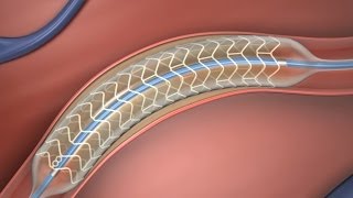 Absorbable Stent [upl. by Airbma374]