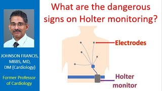 What are the dangerous signs on Holter monitoring [upl. by Annaoj864]