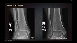 Sports Medicine Case 5 17yearold female A Curious Case of Ankle Pain [upl. by Aneetsyrk]