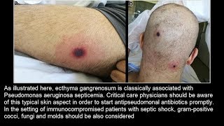 Ecthyma gangrenosum bei Pseudomonas aeruginosa Sepsis [upl. by Pinette]