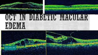 OCT in diabetic Retinopathy  OCT patterns of DME  Biomarkers in OCT [upl. by Nmutua378]