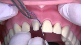 Rétraction gingivale et empreinte définitive [upl. by Yrrek]