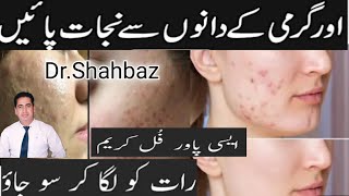 Acne Treatment At Home  Pimples Removel Cream  Acne Soap  Skin Care [upl. by Shae]