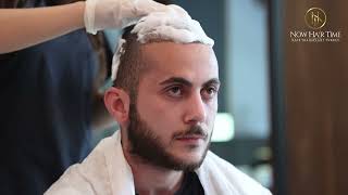 How To Remove The Scabs After Hair Transplant 2023  Now Hair Time [upl. by Eissehc]