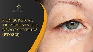 NonSurgical Treatments For Droopy Eyelids Ptosis  Radium Medical Aesthetics [upl. by Naitsirhc122]