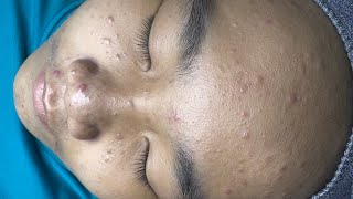 ACNE TREATMENT VU QUYNH MI  Blackheads Perennial EveryWhere Squeeze Cheek 2024 [upl. by Dare]