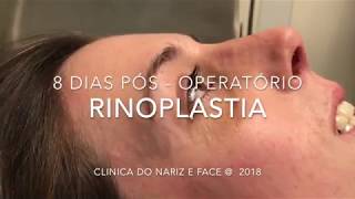 RINOPLASTIA POSOPERATORIO [upl. by Eserehc]