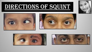 Different Directions of Ocular Deviation  Esotropia Exotropia Hypertropia Hypotropia  Squint [upl. by Maloney]