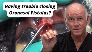 Having trouble closing Oronasal Fistulas [upl. by Malvie221]