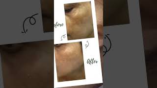 Cosmelan Peel Treatment [upl. by Aural]