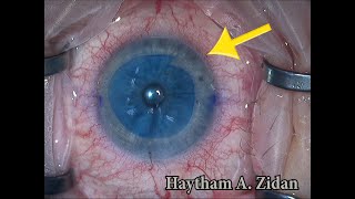 DMEK  Descemet Membrane Endothelial Keratoplasty Double Trephination Technique [upl. by Nnylrebma]