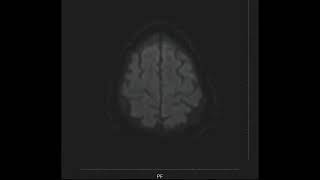 Left Medullary Infarct MRI [upl. by Orabla]