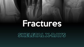 Fractures Skeletal XRays [upl. by Nahshu]