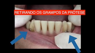 DENTADURA HÍBRIDA APOIADA EM IMPLANTES E DENTES [upl. by Frans]