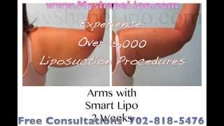 Arms Liposuction Before and After MyShape Lipo [upl. by Fleurette20]