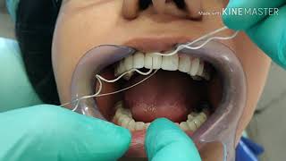 ORAL HYGIENE MAINTENANCE OF DENTAL VENEERS [upl. by Gearalt]