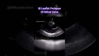 Bileaflet Prolapse of Mitral Valve  AMVL and PMVL echocardiography echocardiogram echo [upl. by Annoyi]