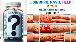 Lisinopril Rash Causes Symptoms and Relief [upl. by Hartfield]