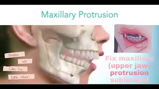 Fix maxillary upper jaw protrusion subliminal [upl. by Siloam510]