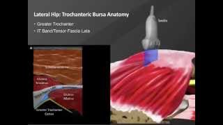 Webinar Ultrasound Guided Hip Injections [upl. by Dopp]