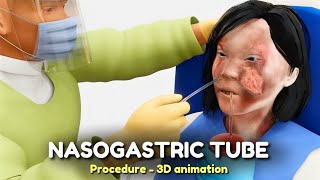 Nasogastric NG Tube Procedure  3D animation [upl. by Beichner]