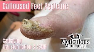 How to Pedicure Extremely Calloused Feet and Toes ASMR [upl. by Amarillis214]