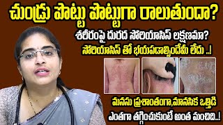 How to Prevent Psoriasis  Skin infection  Scalp Psoriasis Treatment  Medi9 Homeopathy Ayurveda [upl. by Ardnod949]