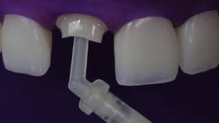 EN Fiberglass Posts and Core Buildups Cementation PROTOCOL [upl. by Cronin]