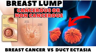 BREAST LUMP Cancerous VS Non  Cancerous  Duct Ectasia or Breast Cancer  Detailed Video [upl. by Darra]