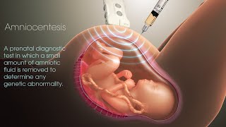 CQIG  Aminocentesis Cordocentesis Fetal Tissue Sampling [upl. by Hulen]