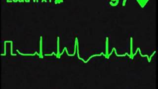 Multifocal Premature Ventricular Contractions PVCs [upl. by Hogue]