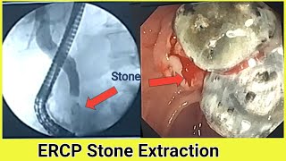 CBD Stone Extraction BDENDOSCOPY [upl. by Saval]