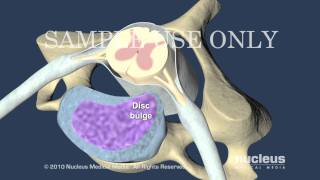 Cervical Disc Herniation [upl. by Cirdet727]