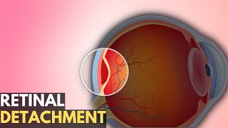 Retinal Detachment Everything You Need To Know [upl. by Dosia]