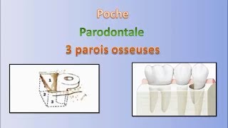 Les poches en parodontologie  Pocket in periodontology [upl. by Nagaem]