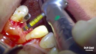 Implant placement 11 narrow ridge Versah burs with bone graft and membrane [upl. by Nosyk885]