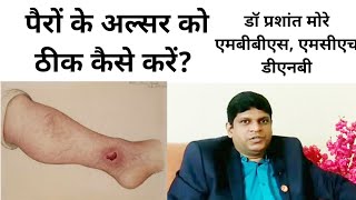 Leg Ulcer Treatment in Hindi  Ulcer Ko Kaise Thik Kare  Alsar Kya Hota Hai [upl. by Evelina]