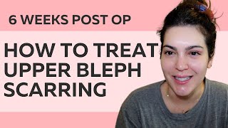 6 WEEKS POST OP UPPER BLEPHAROPLASTY SCARS amp HOW TO TREAT THEM before amp after photos too [upl. by Prober]