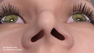 Pinched Narrow Nose Rhinoplasty to Address Nasal Obstruction [upl. by Akinaj]