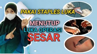 METODE PENUTUPAN LUKA OPERASI SESAR ADA YG PAKAI STAPLES [upl. by Vanhook]