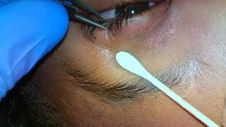 Botulinum toxin Botox injection to the lacrimal gland [upl. by Akina]