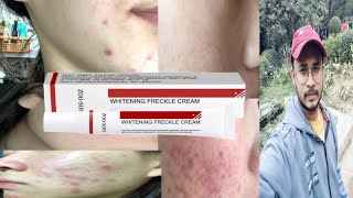 zoo son whitening freckle cream  honest review [upl. by Nunes662]