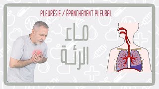 تدويزة  الماء فالرئة TEDWIZA  Pleurésie  épanchement pleural [upl. by Alyks878]