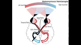 homonemous hemianopia [upl. by Oiril]