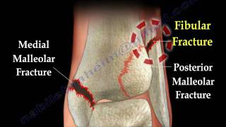 Ankle fracture  Fractures and its repair Everything You Need To Know  Dr Nabil Ebraheim [upl. by Adlen]